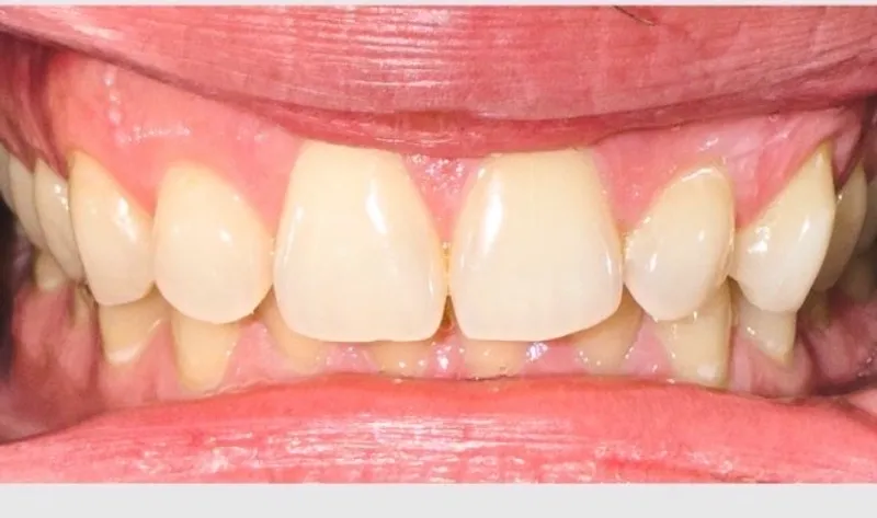 The same patient's teeth after take-home whitening
