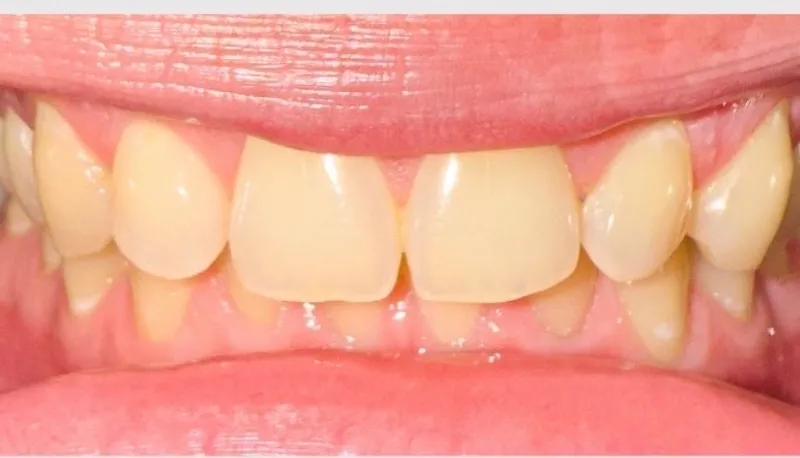 A Wiktorski Orthodontics patient's teeth before take-home whitening