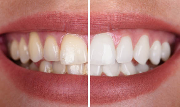 Teeth Whitening - Wiktorski Orthodontics - Rochester NY