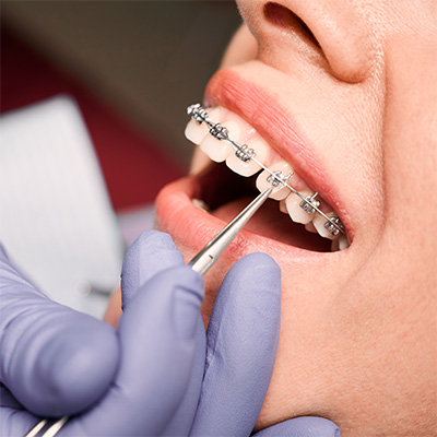 Rochester NY Orthodontist - Wiktorski Orthodontics Braces